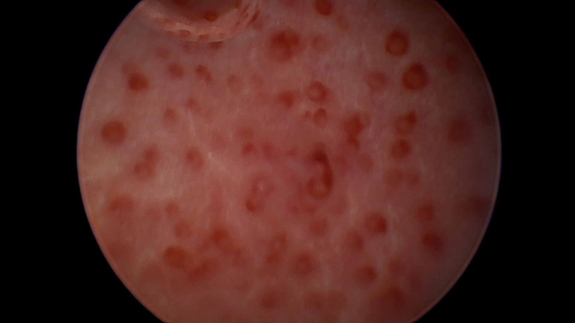 Blaas urachuslitteken Lampe Eva 348 UrethrovaginoCystoscopie 2024 02 09 095816 Brocks Bouvien Still 001