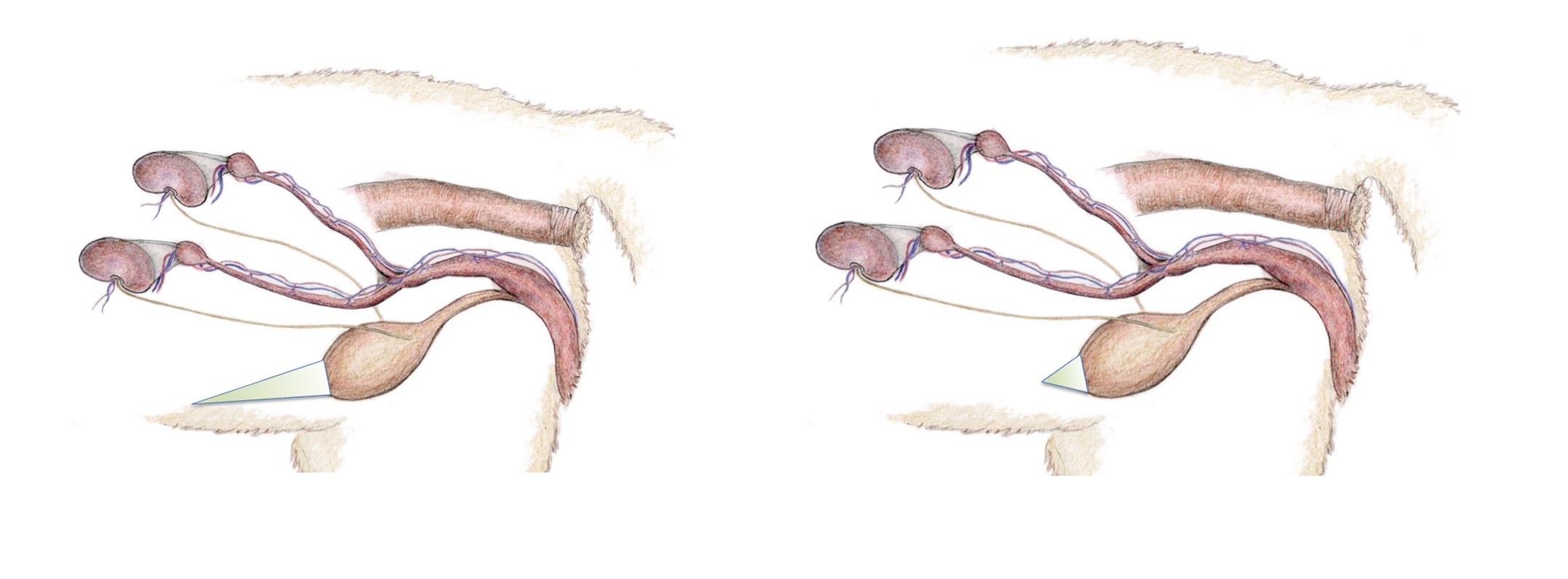 politekening urachus